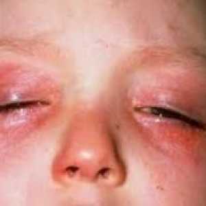 Alergie na očích, jak se projevuje? Jak se chovat?