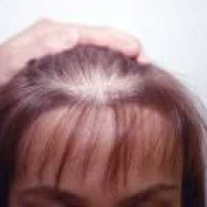 Androgenní alopecie u žen, příznaky, léčba