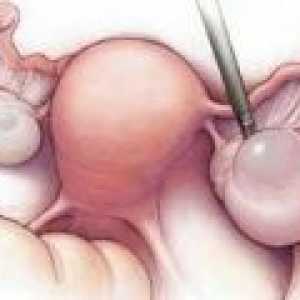 Vaječníků mrtvice: příčiny, příznaky, léčba
