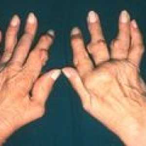 Artritida kloubů prstů: příznaky a léčba