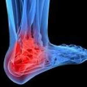 Artróza hlezenního kloubu: příčiny, příznaky, léčba