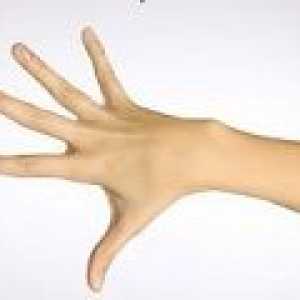 Artróza prstů, klouby na prstech, jak se chovat?