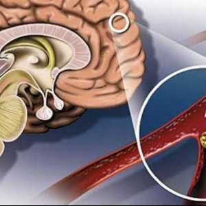 Mozkové příznaky a léčba aterosklerózy