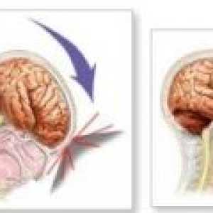 Traumatické poranění mozku - důsledky, rehabilitace