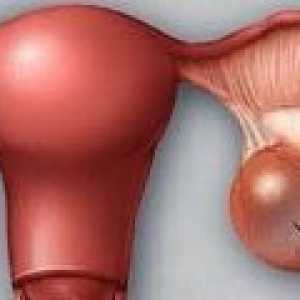 Cystadenom vaječníků - příčiny, příznaky, léčba