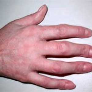 Deformace prstu