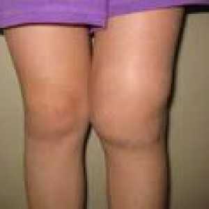 Deformující artróza kolenního kloubu