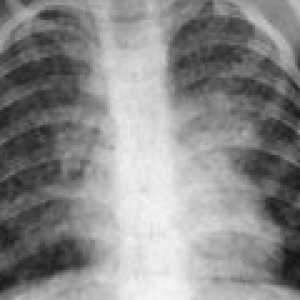 Šířeny tuberkulóza: příčiny, příznaky, léčba