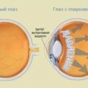 Glaukom - příčiny, příznaky, diagnostika