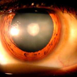 Oční tlak: příznaky a léčba