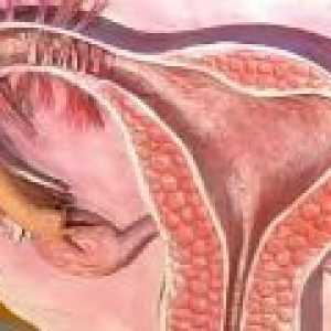 Chronická endometria rakovina - příčiny, příznaky, léčba