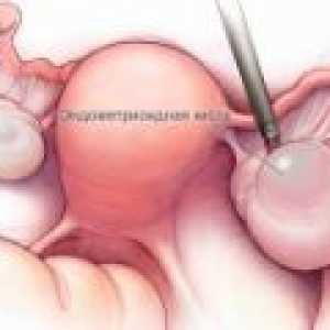 Endometria ovariální cysty - příčiny, příznaky, léčba