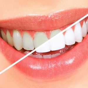 Jak bělení zubů doma
