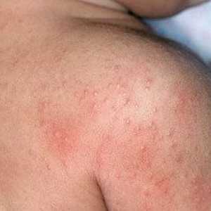 Kožní alergie: příčiny, příznaky, léčba