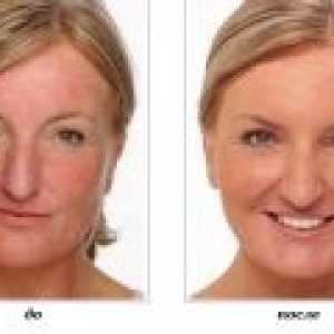Laserové odstranění růžovky na obličeji