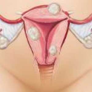 Léčba děložních myomů bez chirurgického zákroku