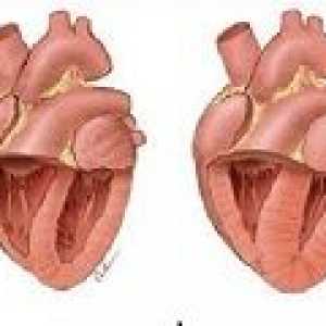 Plicní onemocnění srdce: příčiny, příznaky, léčba