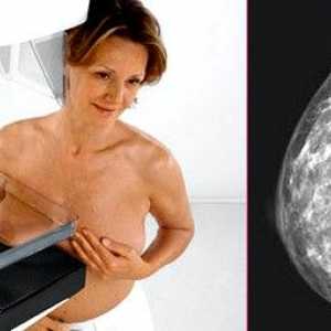 Mamografie prsu