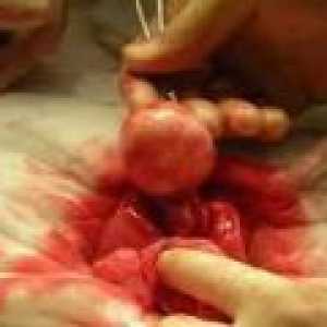 Děložní myomy malé rozměry - příčiny, léčba