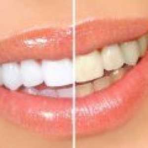 Je možné vybělit zuby doma? Mezi nejoblíbenější způsoby