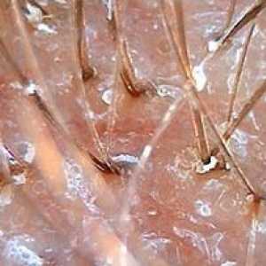 Nejúčinnější způsoby léčení seboroické dermatitidy skalpu