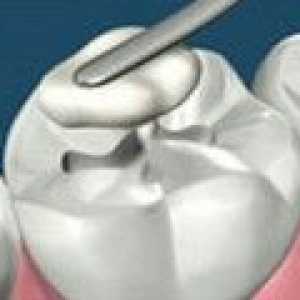 Neobvyklé materiály pro těsnění budou bojovat zubní kaz