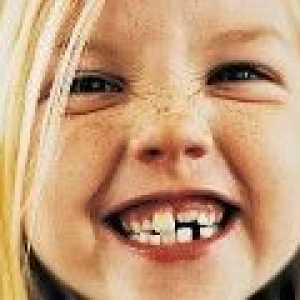 Malocclusion zubů