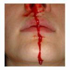 Krvácení z nosu