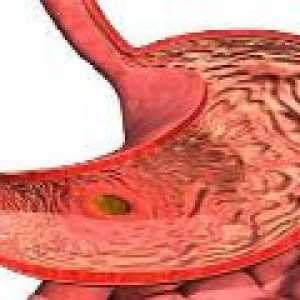 Ohnisková atrofická gastritida: příčiny, příznaky, léčba