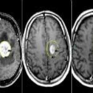 Nádor na mozku - příčiny, příznaky, léčba