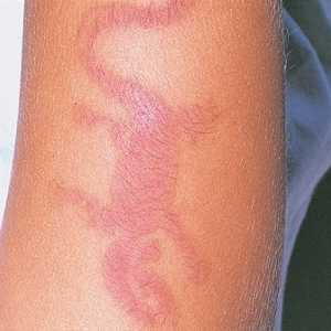 Vlastnosti alergické projevy dermatitidy