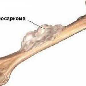 Osteosarkomu (osteogenní sarkom) - příčiny, příznaky, diagnostika a léčba