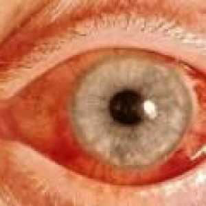 Glaukom s otevřeným úhlem: příznaky a léčba