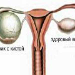 Parovarian cysta vaječníku - příčiny, příznaky, léčba