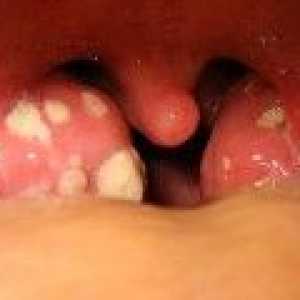 Peritonzilární absces: příznaky, léčba