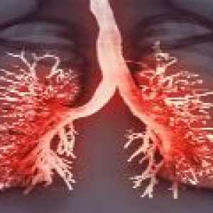 Zánět pohrudnice plíce - příznaky a ošetření zánět pohrudnice