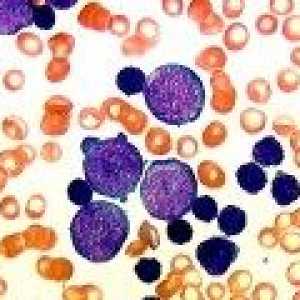 Zvýšení lymfocytů v krvi dospělého, dítě, důvod