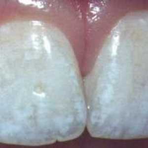 Příčiny bílých skvrn na zubech