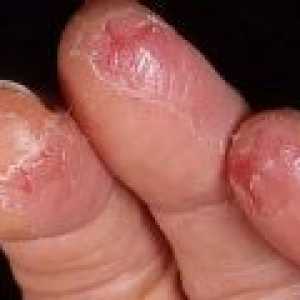 Příčiny a léčba trhlin na ruce a prsty