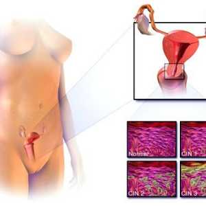 Rakovina děložního čípku: Příznaky a symptomy