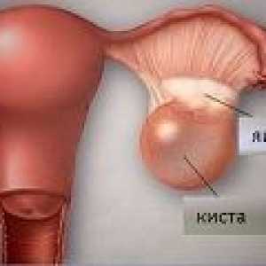 Ruptura ovariální cysty - příčiny, příznaky, léčba
