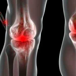 Reaktivní artritida: příznaky a léčba