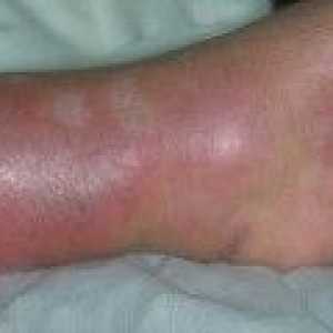 Erysipel nohy - příznaky, léčba
