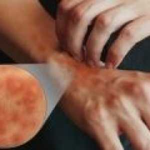 Příznaky a léčba atopické dermatitidy
