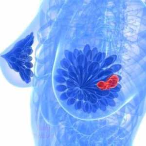 Symptomy a léčba prsu cyst