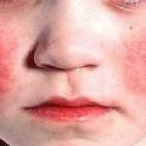 Kawasaki syndrom u dětí: příčiny, diagnostika, léčba