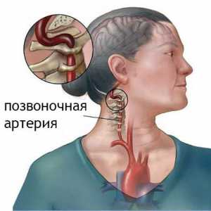 Syndrom páteřního tepny v oblasti krční osteochondróze: příznaky, prevence