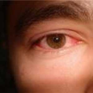 Suché syndrom oční - příčiny, příznaky, léčba