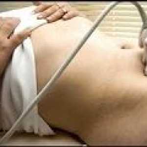 Sklerokistoz vaječníky - příčiny, příznaky, léčba