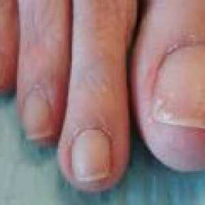 Oloupat nehty - příčiny a léčba